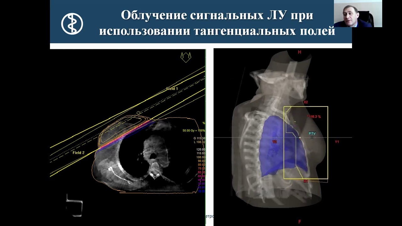 Новиков С.Н. ОФЭКТ/КТ для определения тактики химио-лучевого лечения ...