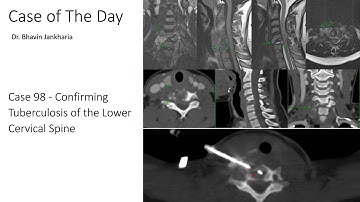 Case of the Day - 098 - 2025 09 08 - Confirming Tuberculosis of the Lower Cervical Spine