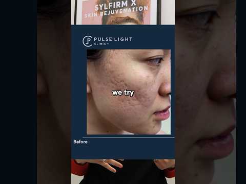 Can OLD Scars be treated?