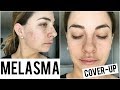 How To Cover Melasma
