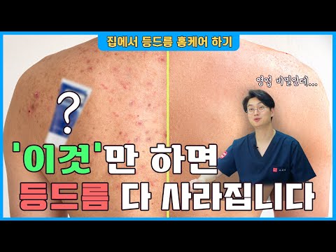 How to Get Rid of Back Acne at Home