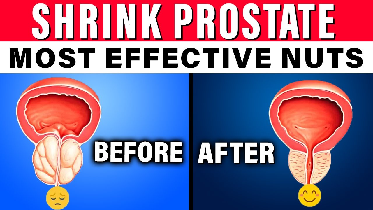 Most effective Nuts To Shrink an Enlarged Prostate Shrink Prostate FAST!!1 YouTube