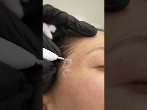 Video: ¿Eliminación de verrugas en la piel con hemorroides en casa?