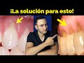 Retraccin de enca y desgaste en cuello de los dientes cmo se soluciona y qu lo provoca