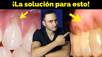 ¿Se me caerán los dientes por la retracción de las encías?