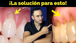 Retracción de encía y Desgaste en cuello de los dientes ¿Cómo se soluciona y qué lo provoca?