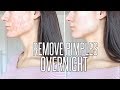 How To Get Rid Of Pimples OVERNIGHT