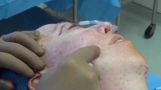 Minilift, SMAS lift, Deep Plane: What are the differences? by Dr. Mark Glasgold, New Jersey