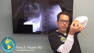 Neck pain after C5C6 disc replacement surgery  DMX review with Ross Hauser, MD
