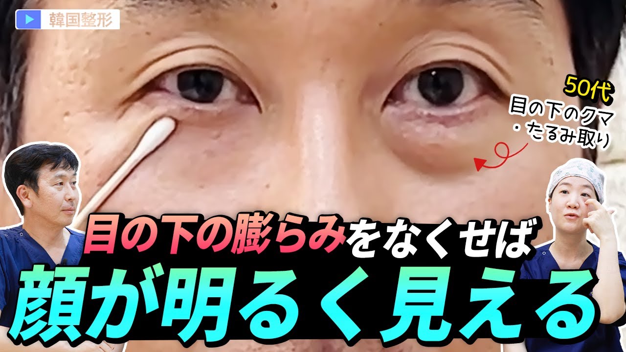 #目の下の膨らみ #下眼瞼 #目の下脂肪再配置