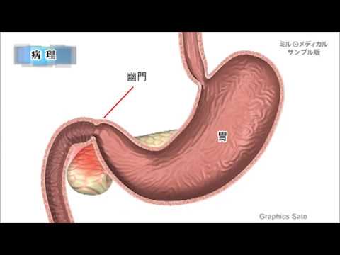 胃幽門狭窄症／2分で分かる医療動画辞典　ミルメディカル