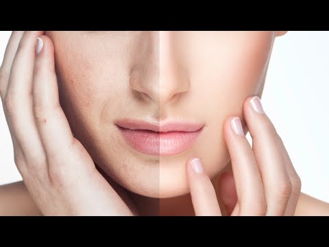 caseros remedios hemorroides Blanquea tu rostro hasta 2 tonos con está mascarilla👌