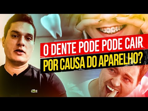 Vídeo: O Que é O Arnês Ortodôntico E Como Ele Ajuda A Endireitar Os Dentes?