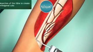 HOW LEG BONE SURGERIES ARE DONE كيف تتم جراحه عظم الساق @channelAhmedGemiay3