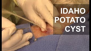 Explosive Idaho Potato Cyst Dr Derm