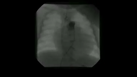 Lillian's Cardiac Cath A1