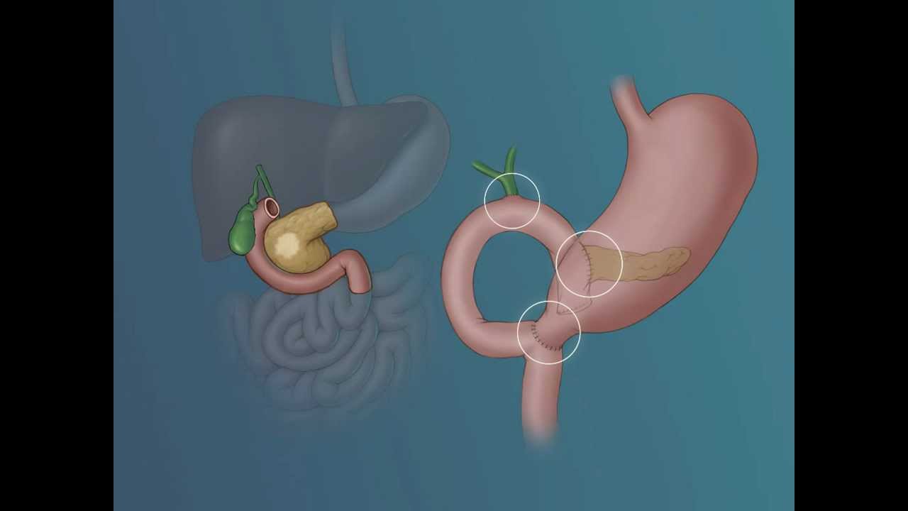 Whipple Procedure Johns Hopkins Medicine