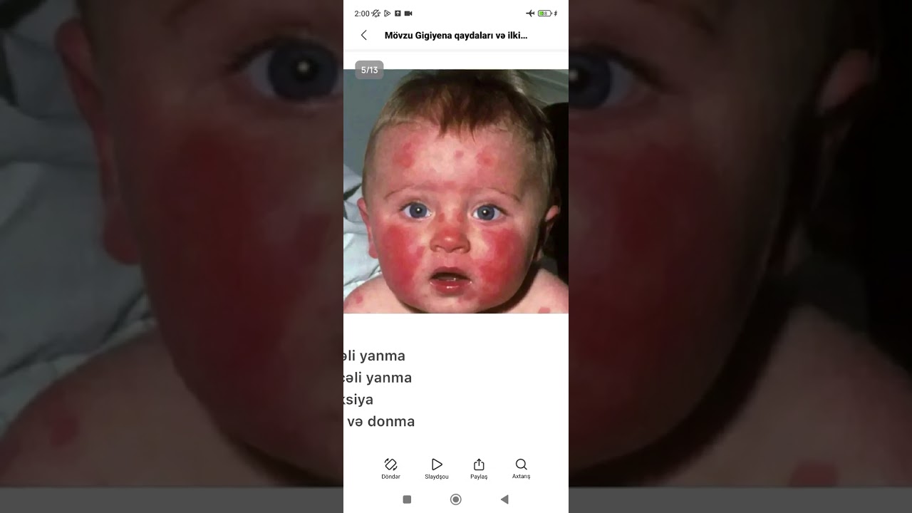 TEST İZAHI. DİAQNOSTİKA. Gigiyena qaydaları və İlkin tibbi yardım #bağça #ilkyardım #test #