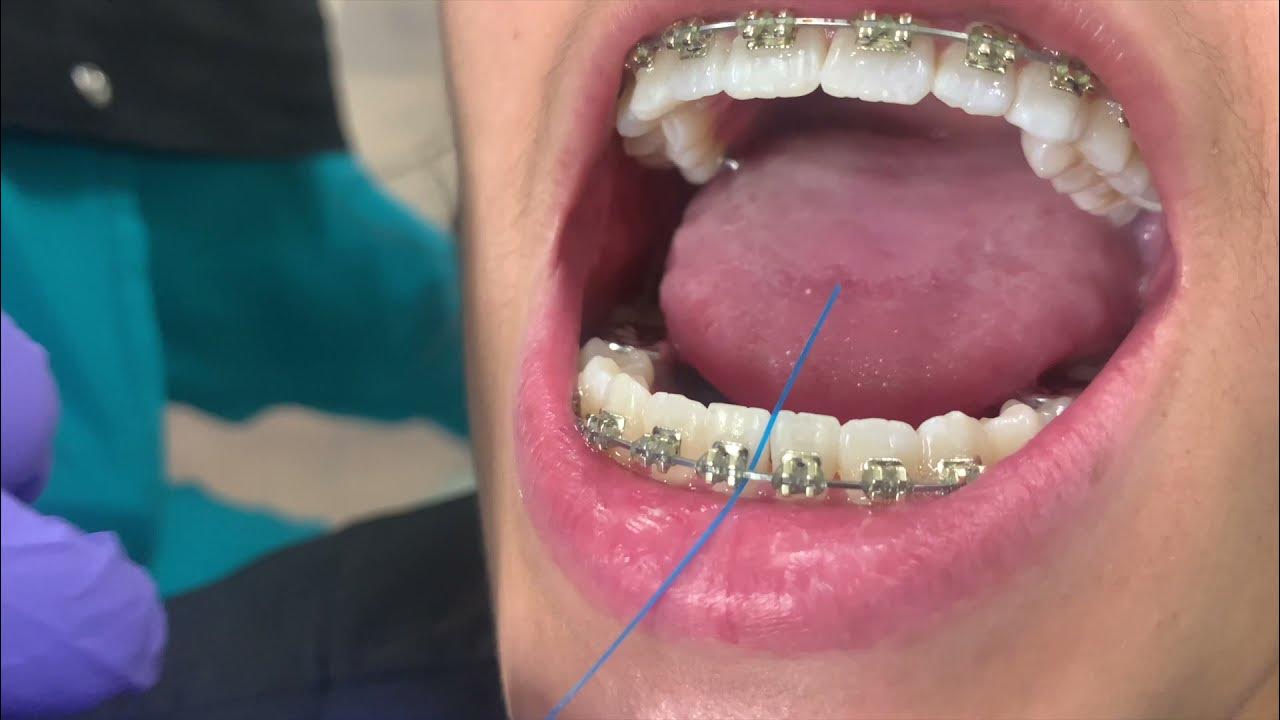 How to Floss with Braces YouTube