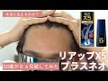 【発毛剤】リアップX5プラスネオを33歳が6ヵ月試した結果