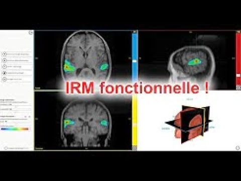 IRMf et EduAnat2 : interpréter correctement une IRM fonctionnelle     les pièges à éviter