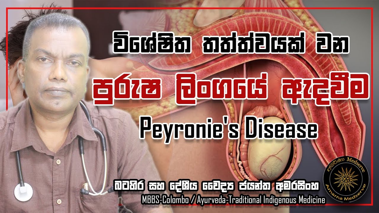 Pyrones Real විශේෂිත තත්ත්වයක් වන පුරුෂ ලිංගයේ ඇදවීම | Peyronie's Disease - YouTube
