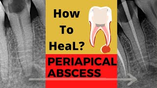 Case of PERIAPICAL ABSCESS| Dr. Sunil kumar| Dental ji Case of PERIAPICAL ABSCESS| Dr. Sunil kumar| Dental ji