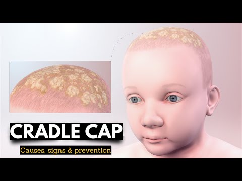 Cradle Cap, Causes, Signs and Symptoms, Diagnosis and Treatment.