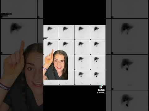 Nuclear Medicine Explained HIDA scan