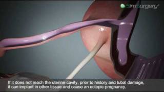 Ectopic Pregnancy