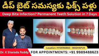 Deep Bite Problem Solved with Immediate Loading Dental Implants at LBR Dental Hospital Hyderabad