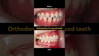 Orthodontic treatment in Korea for foreigners with gap teeth, #Braces #smile #koreadentist