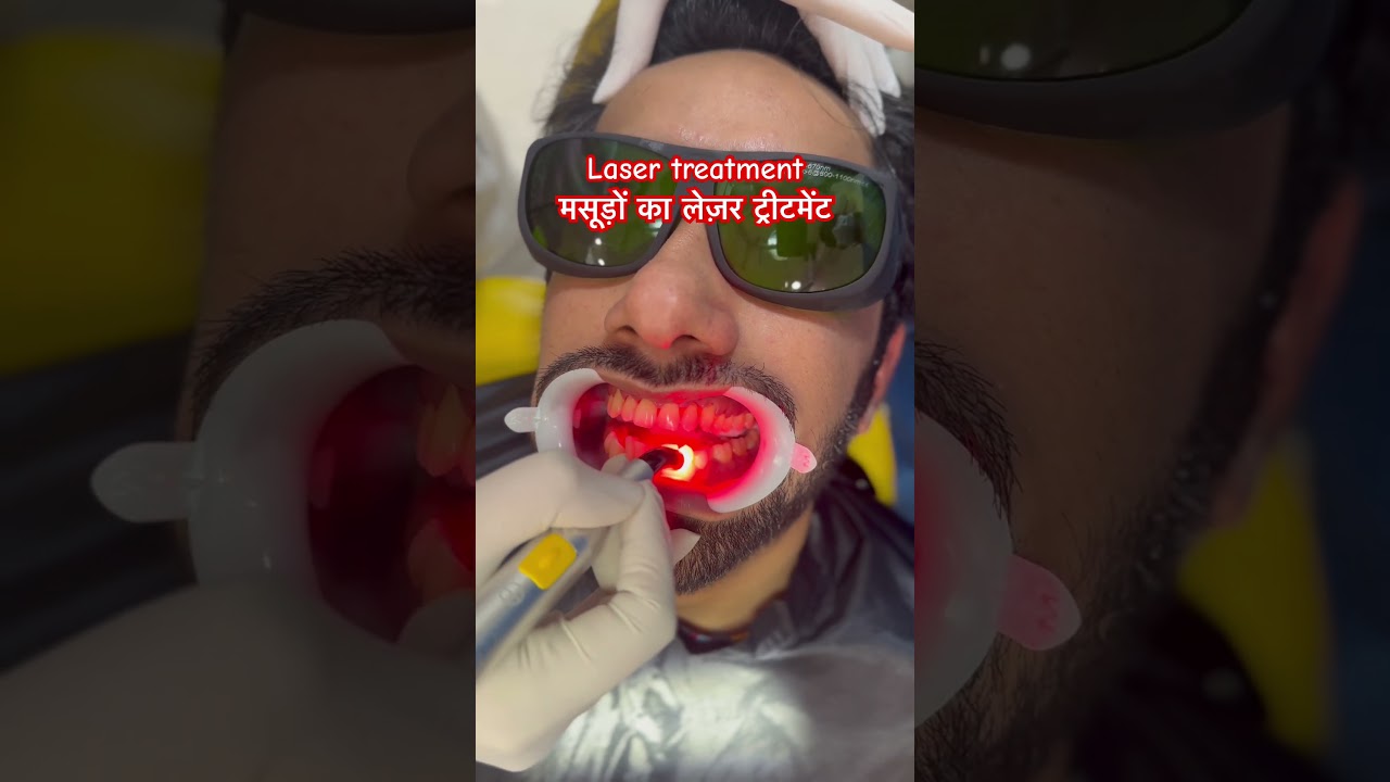 मसूड़ों का लेज़र ट्रीटमेंट laser treatment for weak gums #dental #healthtips #beautyhacks #trending मसूड़ों का लेज़र ट्रीटमेंट laser treatment for weak gums #dental #healthtips #beautyhacks #trending