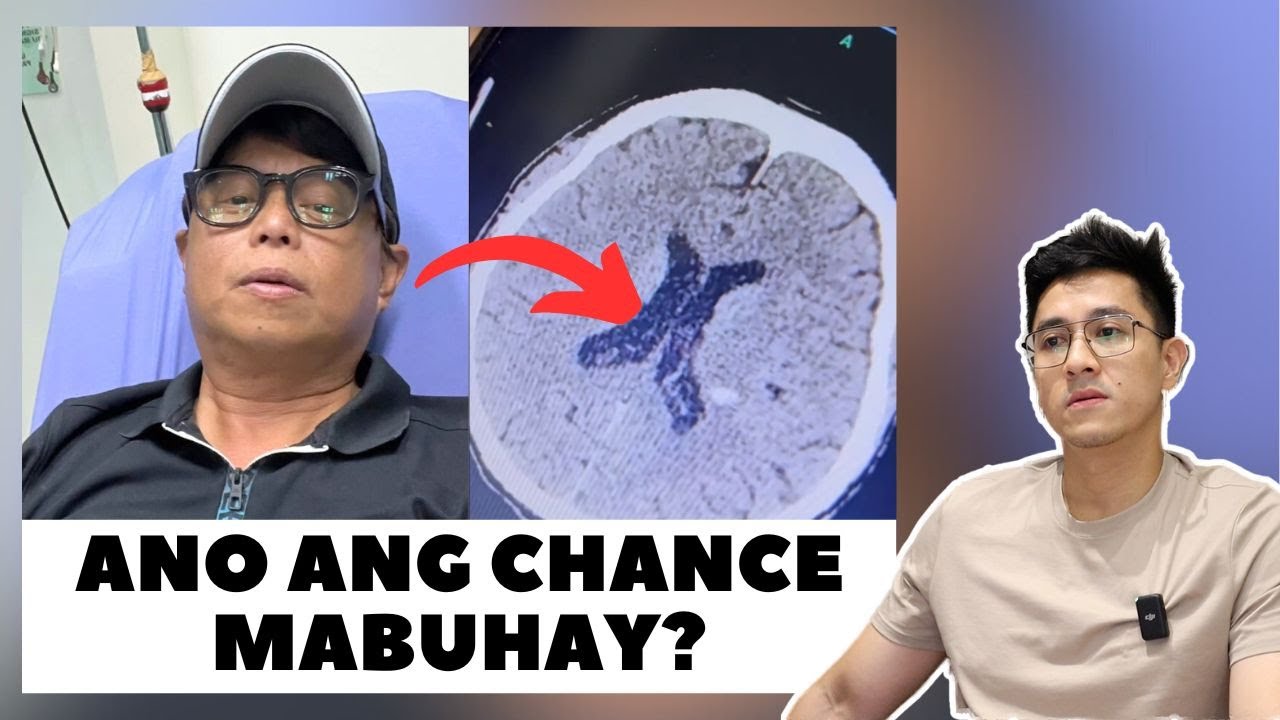 IGAN ARNOLD CLAVIO, MAY PAGDURUGO SA ULO. SAN NAKUHA AT PANO MAKAIWAS?