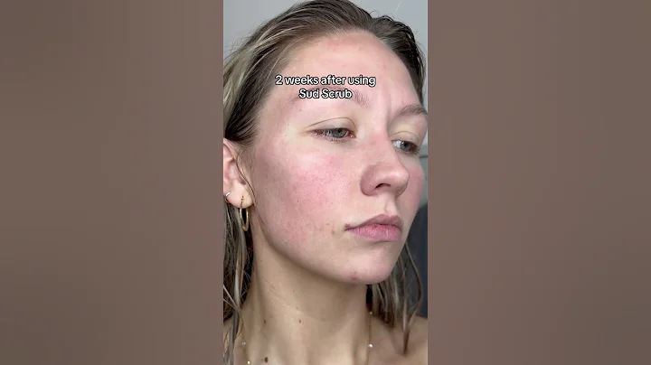 JAW DROPPING…#skinjourney #skintransformation #acneproneskin #sudscrub #facescrubber