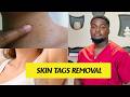 Don't skip this skin tags removal #healthylifestyle #health #dailyroutine #skincare #skintreatment