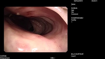I - SCAN Colonoscopy showing mutiple ulcers in infective colitis