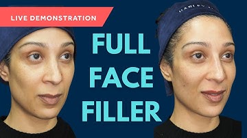 Gabriella’s Live Full Face Filler Treatment: Soft Corrections, Refined Results Using GEM©️ 💎