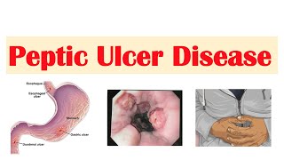 Peptic Ulcer Disease (Gastric vs. Duodenal Ulcers) | Causes,  Symptoms, Diagnosis, Treatment