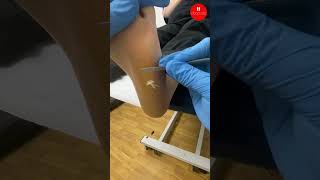 Lateral Forefoot Callus Removal