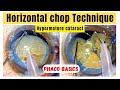 Phaco basics horizontal chop technique in free floating nucleus  hypermature cataract