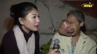 Nổi Đau Của Bà Bông Khi Bị Khối U Trên Mặt