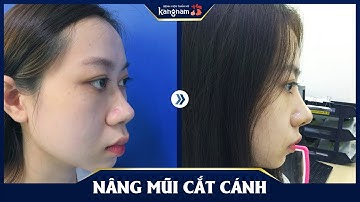 Nâng mũi và cắt cánh mũi tại Kangnam