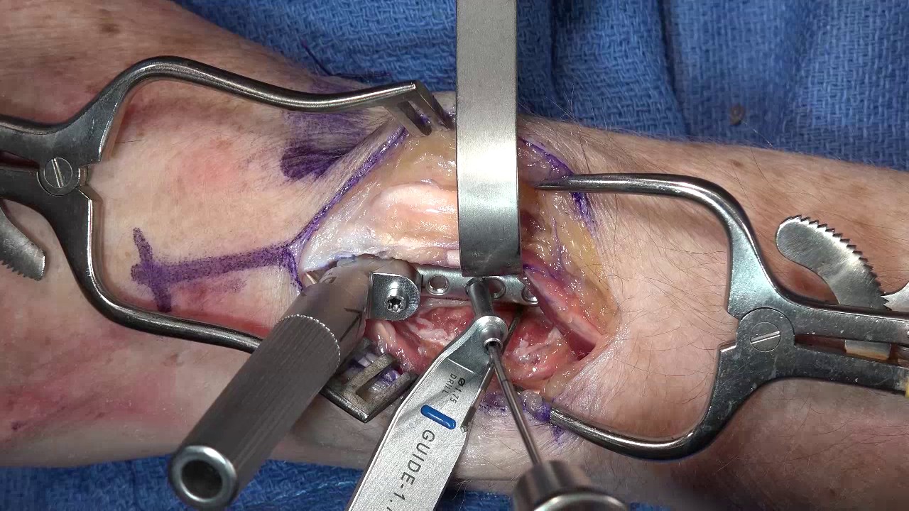 Dorsal Hook Plate Surgery YouTube