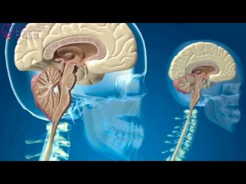 아놀드 키아리 증후군 제1형, 척수공동증, 척추측만증 - Institut Chiari de Barcelona