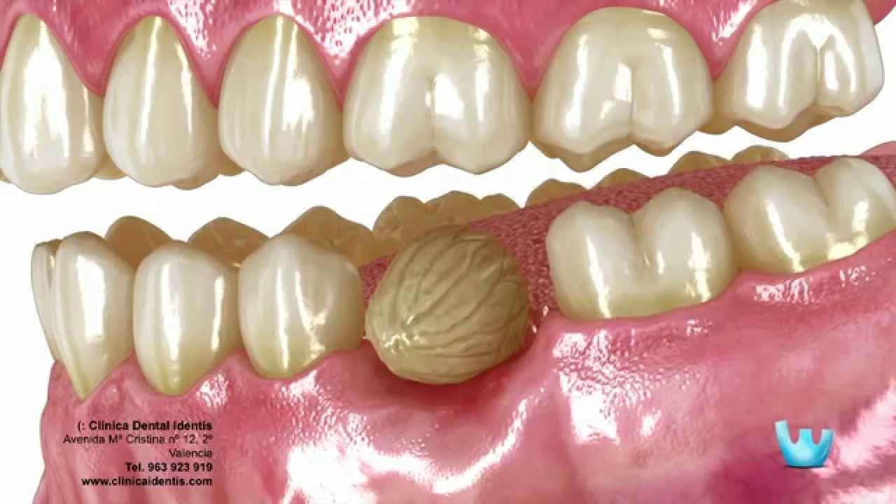 Removible dental cuesta una cuanto protesis