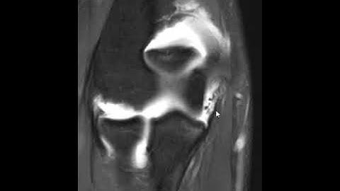 UCL partial tear from sublime tubercle
