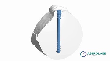 Astrocan - Cannulated Screw Mechanism of Action