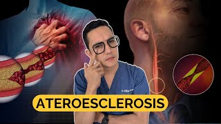 ATHEROSCLEROSIS: Everything You Need to Know | Dr. William Guerrero