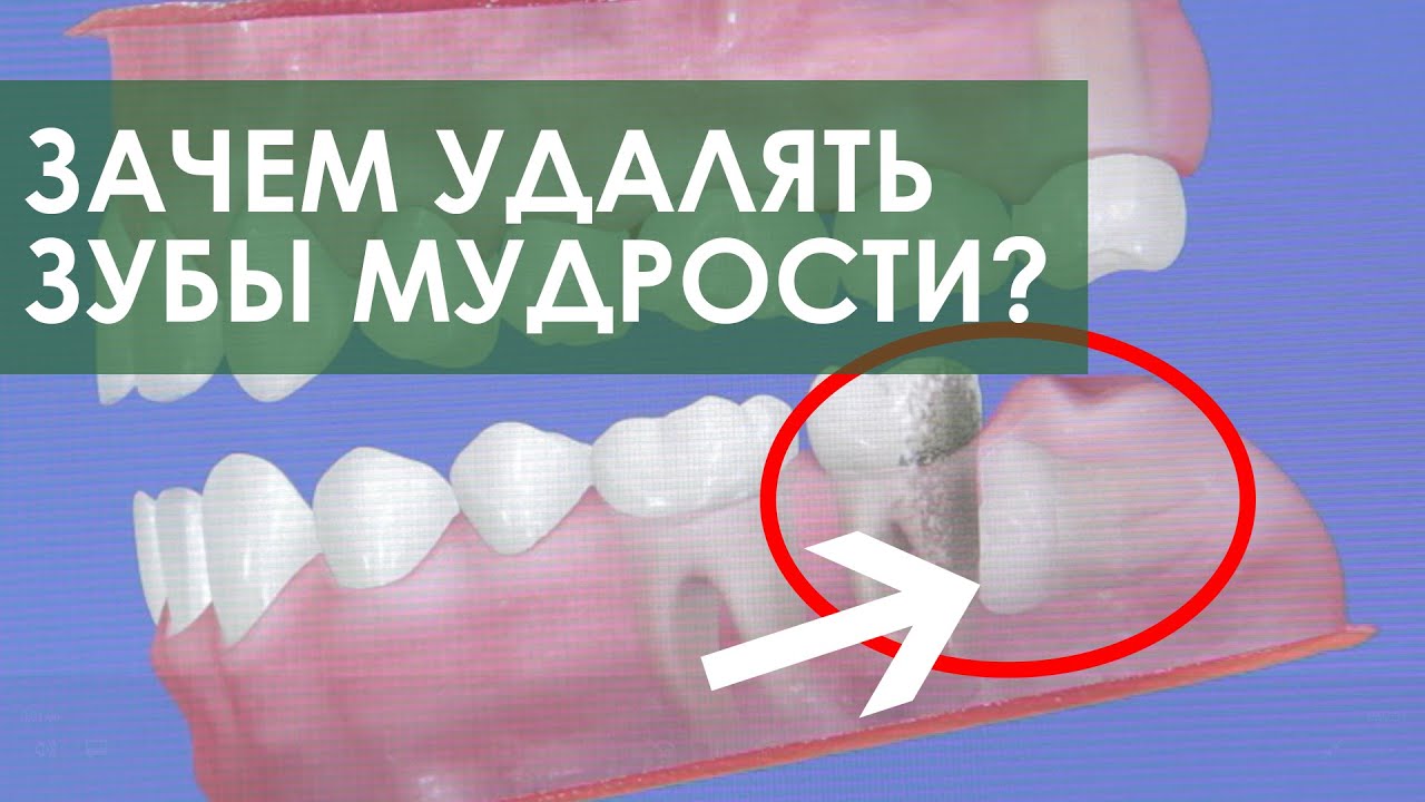 Удаление зубов мудрости. Стоматология ПрезиДЕНТ в Марьино - YouTube